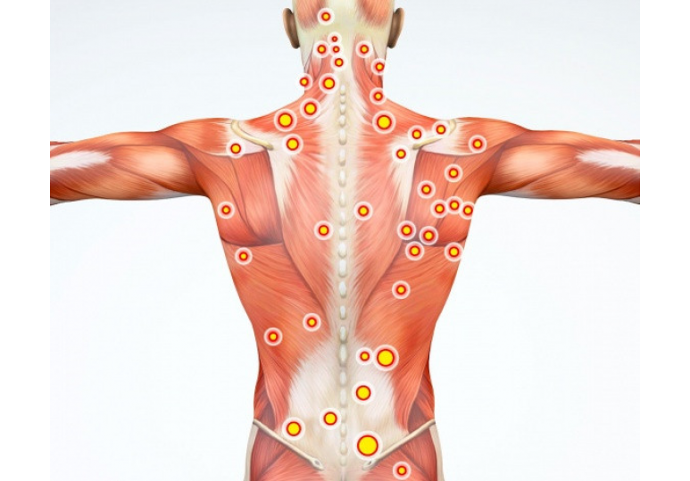 What are trigger points?