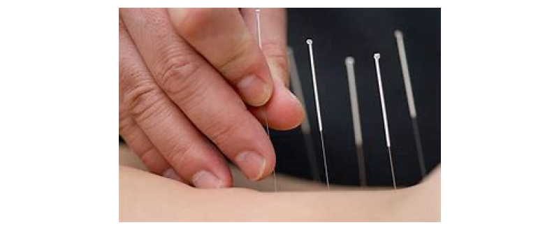 TCM Acupuncture